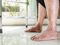 Apa Ciri-ciri Penyakit Diabetes yang Sudah Parah? Berikut 8 Daftarnya